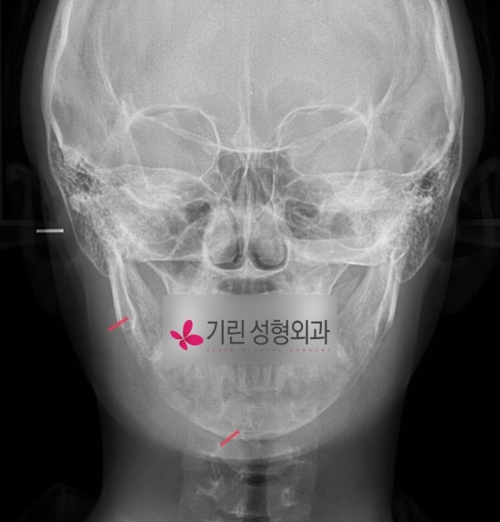 긴곡선 브이라인수술 엑스레이 (귀밑각부터 턱끝까지) 관련 이미지 2