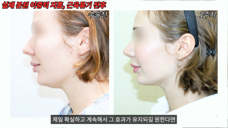 [기린성형외과] 윤곽수술후 살처짐 회생불가? 관련 이미지 8