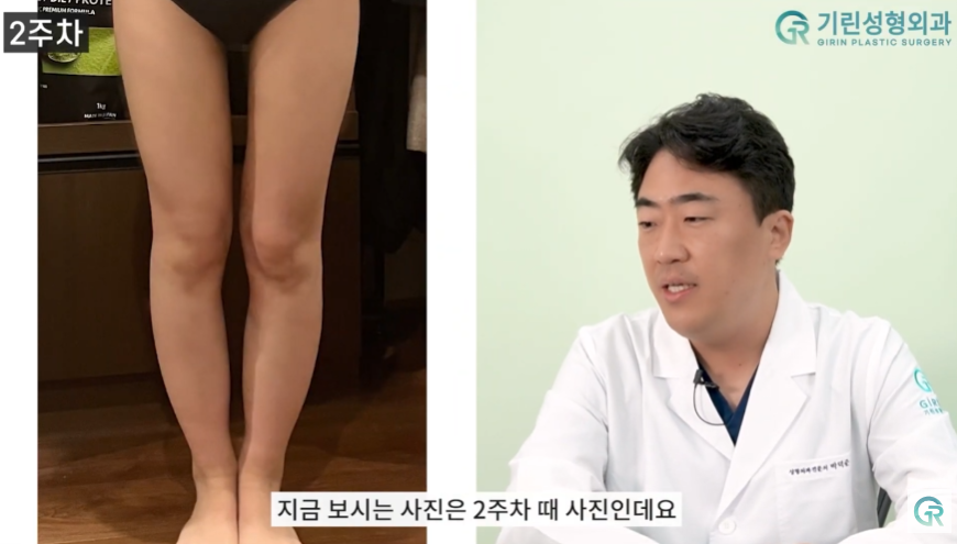 [기린성형외과의원] 뼈벅지?허틈!_허벅지지방흡입 수술일지 관련 이미지 8