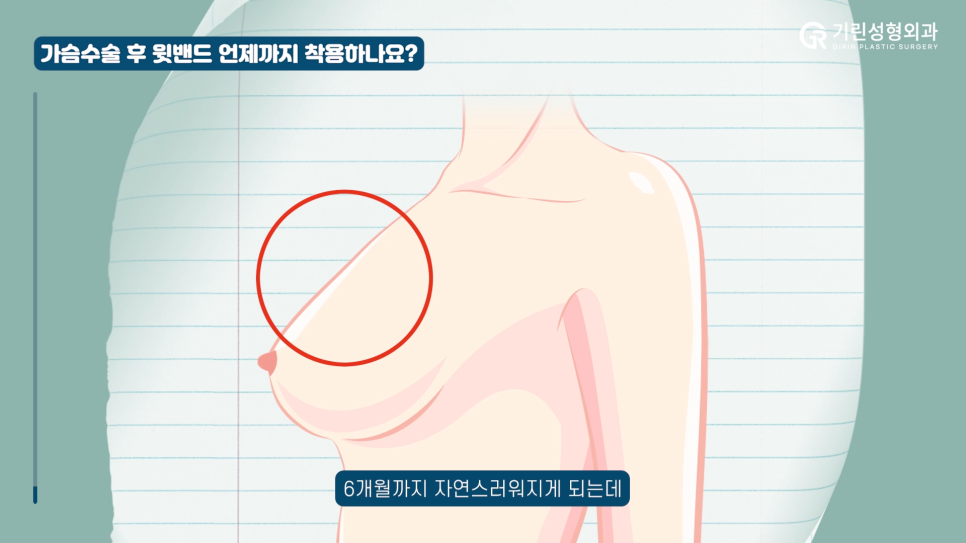 [기린성형외과] 가슴수술 부작용 주의사항! 관련 이미지 4