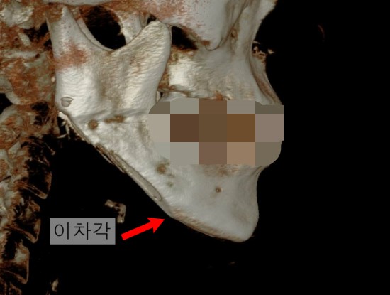 턱끝까지 자르는 혹은 그렇지 않은 긴곡선절제술 관련 이미지 1