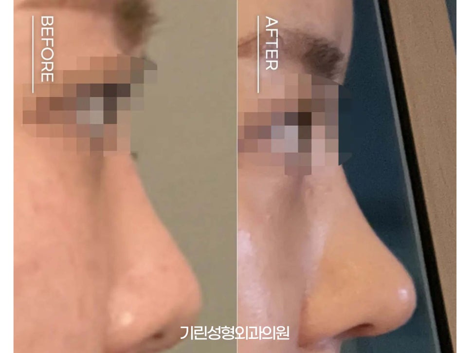 낮은코성형후기 차이점을 고려하여 관련 이미지 3