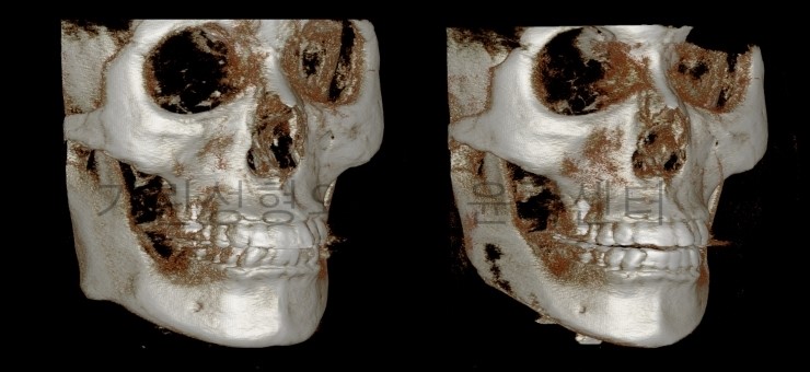 긴곡선+아큐스컬프+귀족수술 7게월 경과 관련 이미지 4