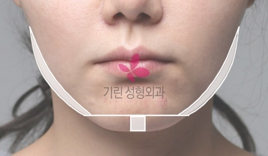 티절골로 제거된 실제 뼈모양과 위치 관련 이미지 1