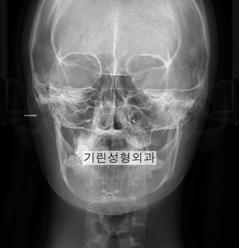 미니브이라인 후 얼굴이 더 넓어보이는 경우 관련 이미지 1