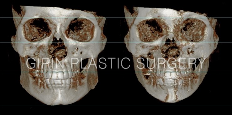 긴곡선브이라인 16일째 경과 관련 이미지 4