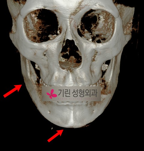 효과미비로 인한 사각턱재수술사례 관련 이미지 4