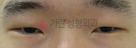 실밥제거가 없는 비절개눈매교정술 (전후사진) 관련 이미지 1
