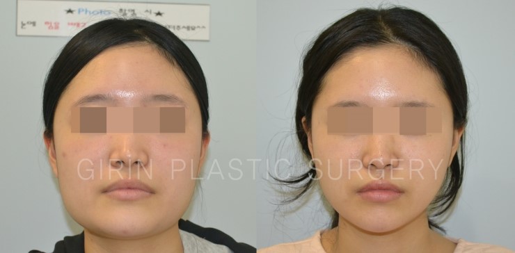 뉴브이라인, 아큐스컬프 6개월 경과 관련 이미지 4