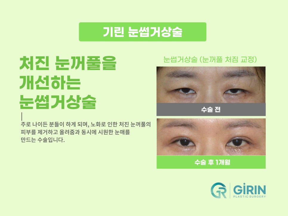 상안검수술잘하는곳 알아본다면 관련 이미지 10