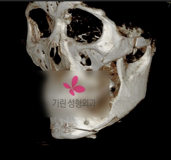 앞턱수술의 효과 관련 이미지 2