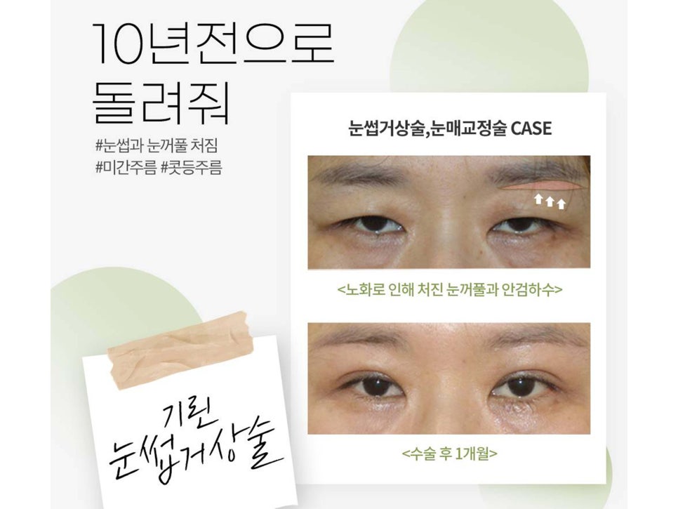 눈썹거상술흉터 걱정하고 있었다면 관련 이미지 1