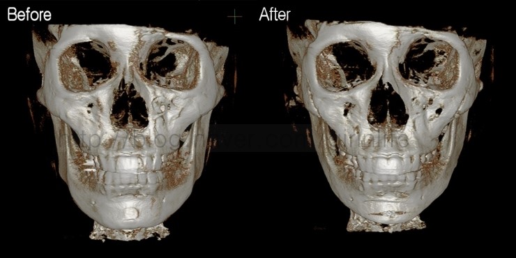 긴곡선절골로 앞턱길이를 함께 줄인 경우 관련 이미지 1