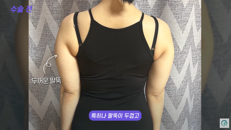 [기린성형외과] 뼈 팔뚝 된 비결 알려줄게_팔뚝 지방흡입 수술일지 관련 이미지 5