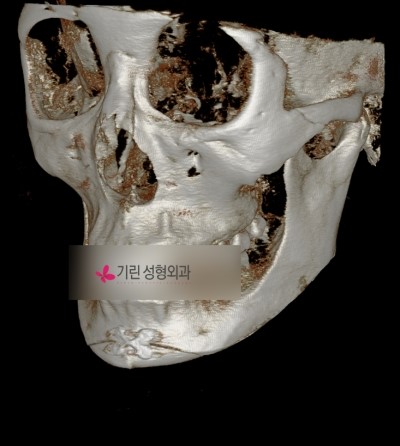 턱의 길이를 줄여주는 턱끝수술[앞턱길이줄임술] 관련 이미지 2