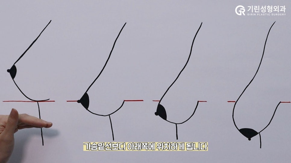 [기린성형외과의원] 다이어트 후 작고, 처진가슴 개선방법_가슴성형 수술일지 관련 이미지 5