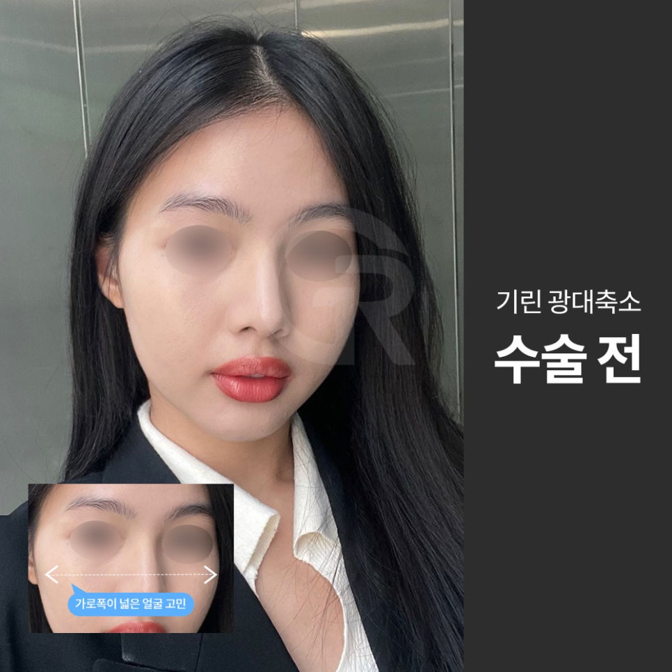 광대가 큰 얼굴, 축소술은 인상을 조율하는 기준점입니다 관련 이미지 1