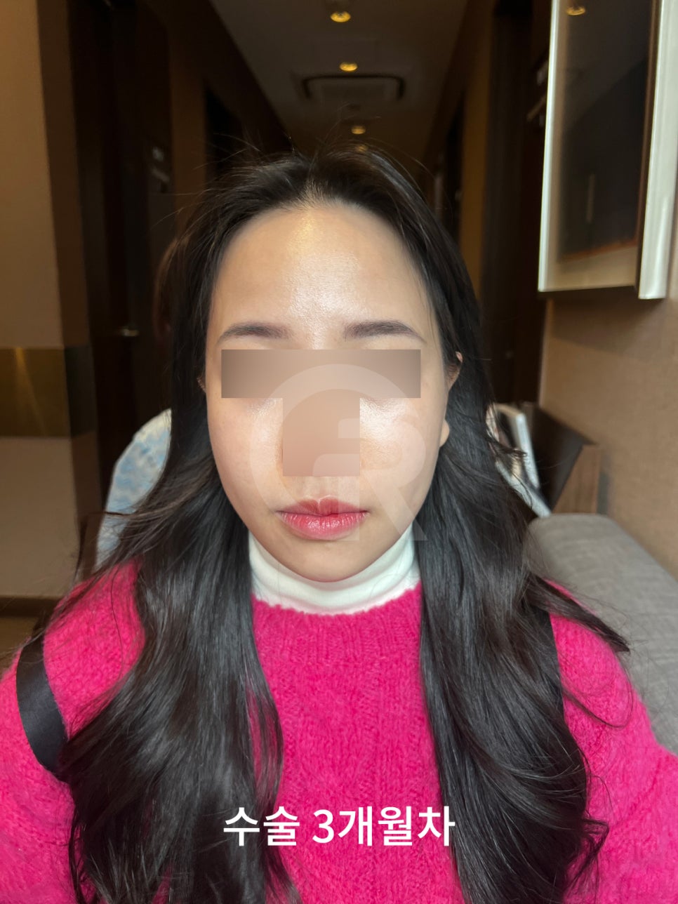 연조직윤곽술, 시간이 지날수록 자연스러운 얼굴선 관련 이미지 5