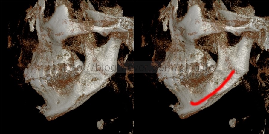 윤곽수술의 위험성과 안전성 관련 이미지 1