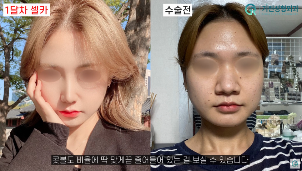 [기린성형외과의원] 코끝과 콧볼 교정으로 얄쌍해진 코_복코성형 수술일지 관련 이미지 4
