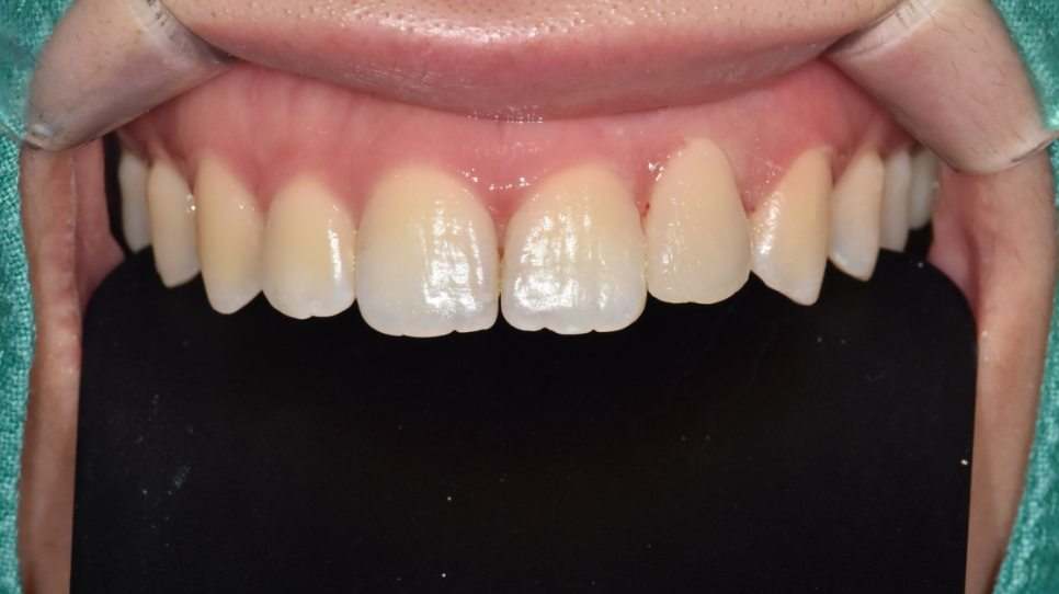 앞니 레진 변색으로 무삭제 라미네이트 진행했습니다. 관련 이미지 7