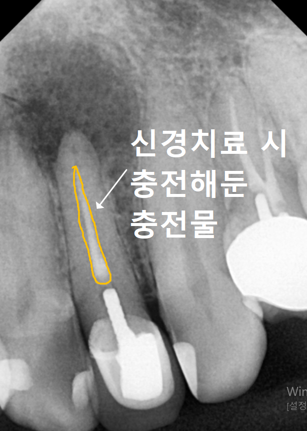 강동구 재신경치료, 왜 첫 치료보다 성공률이 낮다고 할까요? 관련 이미지 2