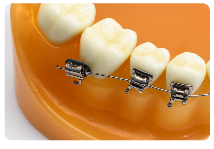 Orthodontic Bracket Debonding: Please Pay Attention If You Have Many Prosthetic Restorations image 1