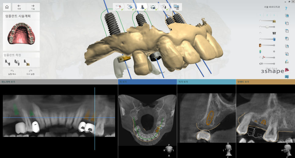 뿌리만 남은 치아, 그대로 두면 왜 위험할까요? 고덕동 전체 임플란트 재건 사례 관련 이미지 12