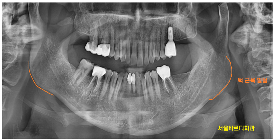 강동구 임플란트 위 아래 어금니 동시 식립으로 치료기간 대폭 축소 관련 이미지 3