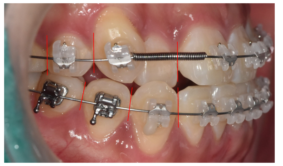 Are There Any Side Effects of Interproximal Reduction During Orthodontic Treatment? Click Here If You’re Concerned image 2