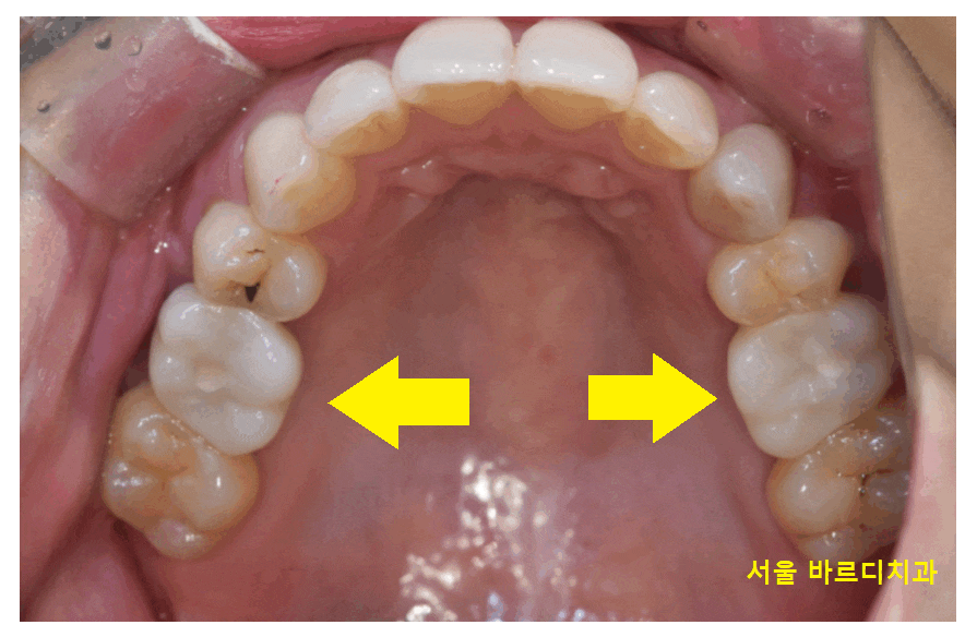 풍산동 치과 임플란트 양쪽 치료 가능한가요? 관련 이미지 1
