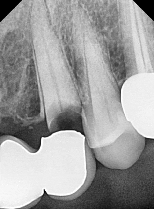 오래된 앞니 크라운 냄새, 관련 이미지 5