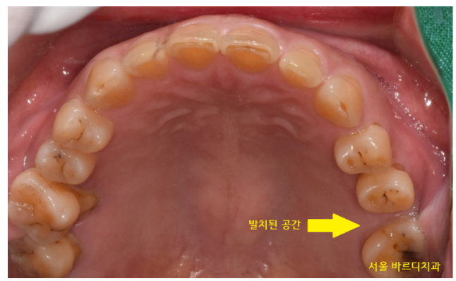 강동구 치과 약먹는게 많은데 임플란트 수술 할 수 있나요?? 관련 이미지 3