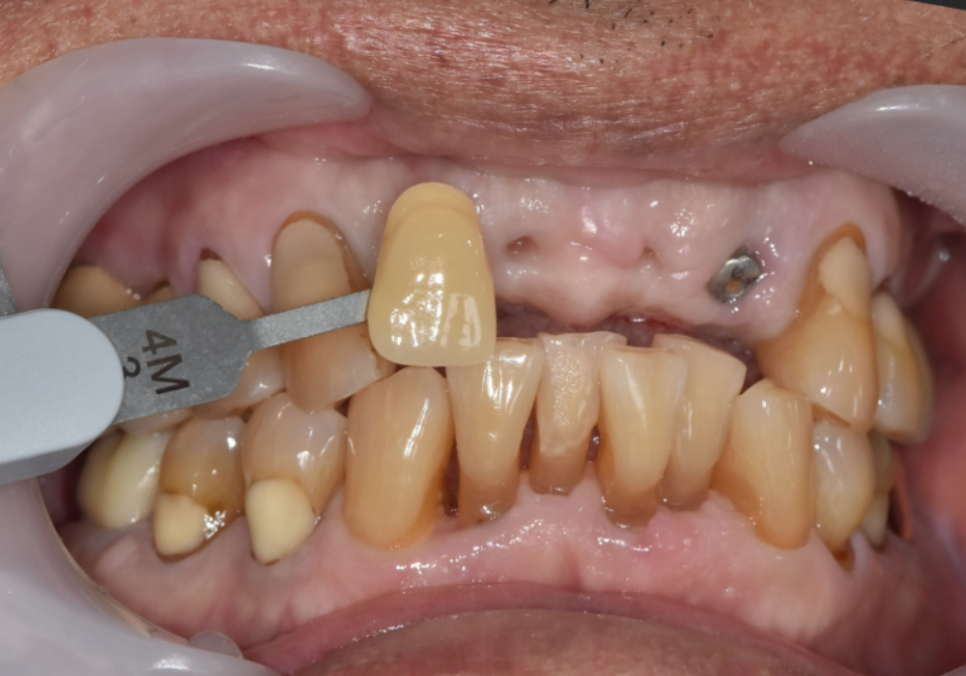 상일동역 치과 앞니 임플란트 기간 때문에 망설이신다면 꼭 보세요. 관련 이미지 11