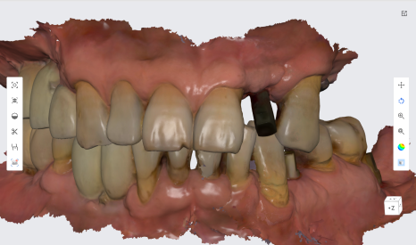 네비게이션 임플란트가 왜 좋다고 그러는거죠? (feat.13가지 장점) 관련 이미지 13
