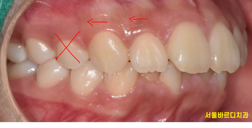 이 안뽑고 교정 안되나요? 발치 교정 케이스를 정리합니다! 관련 이미지 5