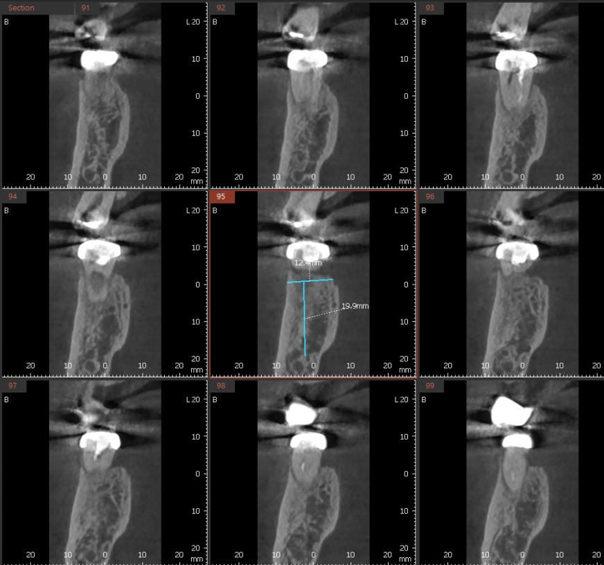 신경치료 후 통증 치아 뿌리 금으로 발치 후 강일역 임플란트 관련 이미지 5