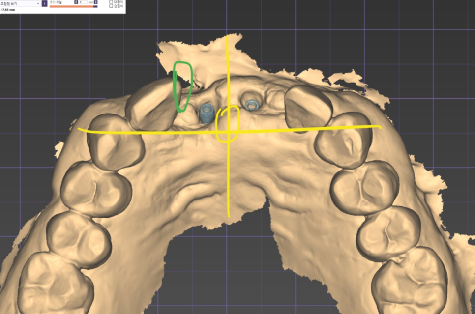 대문니 빠짐, 앞니 빠졌을 때 브릿지와 임플란트 중 나에게 맞는 선택은? 관련 이미지 15
