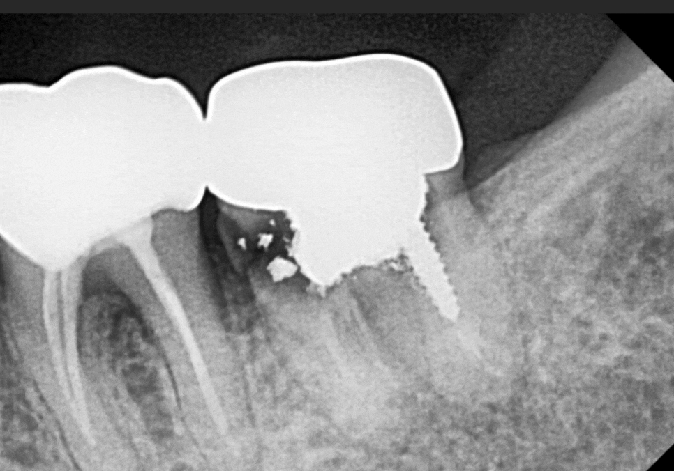 고덕역 임플란트, 뼈이식 꼭 해야 할까? 필수 상황 vs 제외 상황 총정리 관련 이미지 6