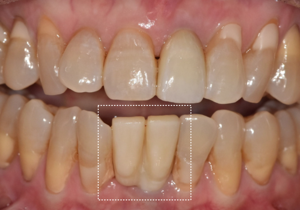고덕동 아래 앞니 임플란트 비용 줄이는 비법, 공개합니다. 관련 이미지 13