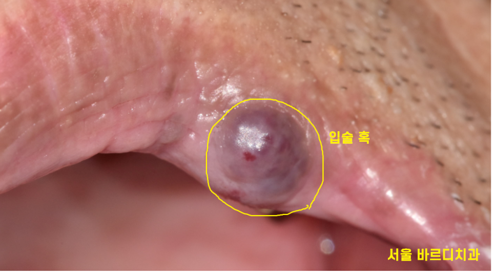 입술 혹 씹었을때 부풀고 딱딱 하다면 간단히 제거하세요 관련 이미지 2