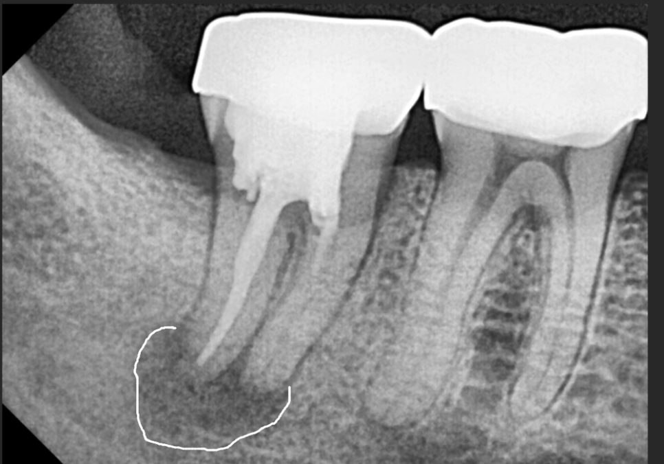 강동구 임플란트 기간, 사람마다 왜 다를까? 즉시식립과 지연식립의 결정적 차이 관련 이미지 3