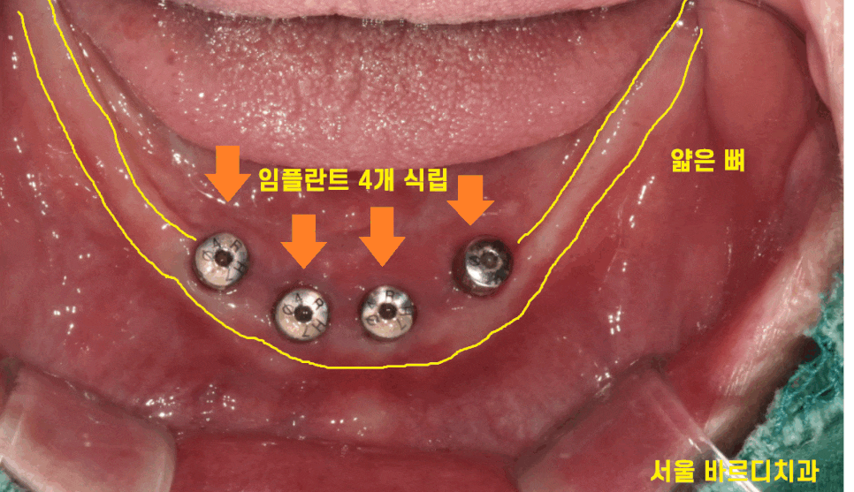 상일동 근처 치과 얇은뼈 틀니 안될 때 해결 방법은?? 관련 이미지 1