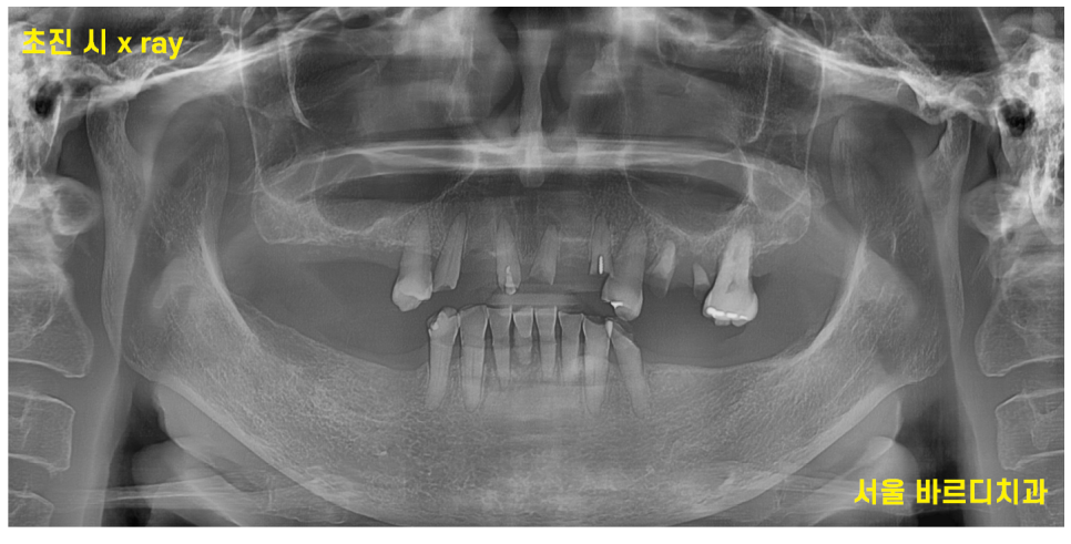 전체적인 치아 치료 13개의 임플란트를 식립한 환자분 관련 이미지 2