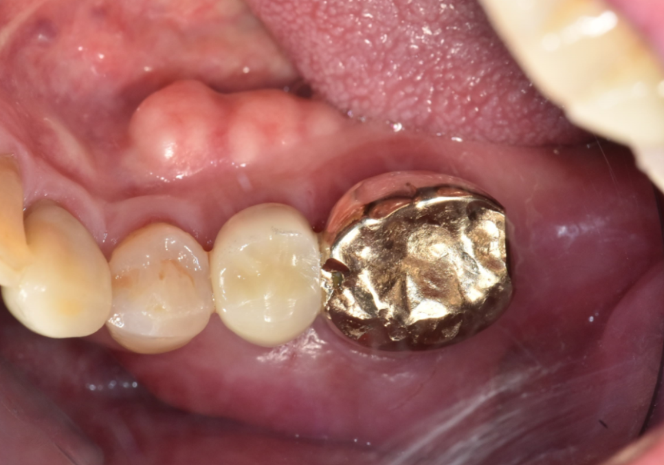 상일역 치과, 오래된 금니 빠짐, 같은 증상으로 내원했지만 전혀 다른 결과, 그 차이는? 관련 이미지 12