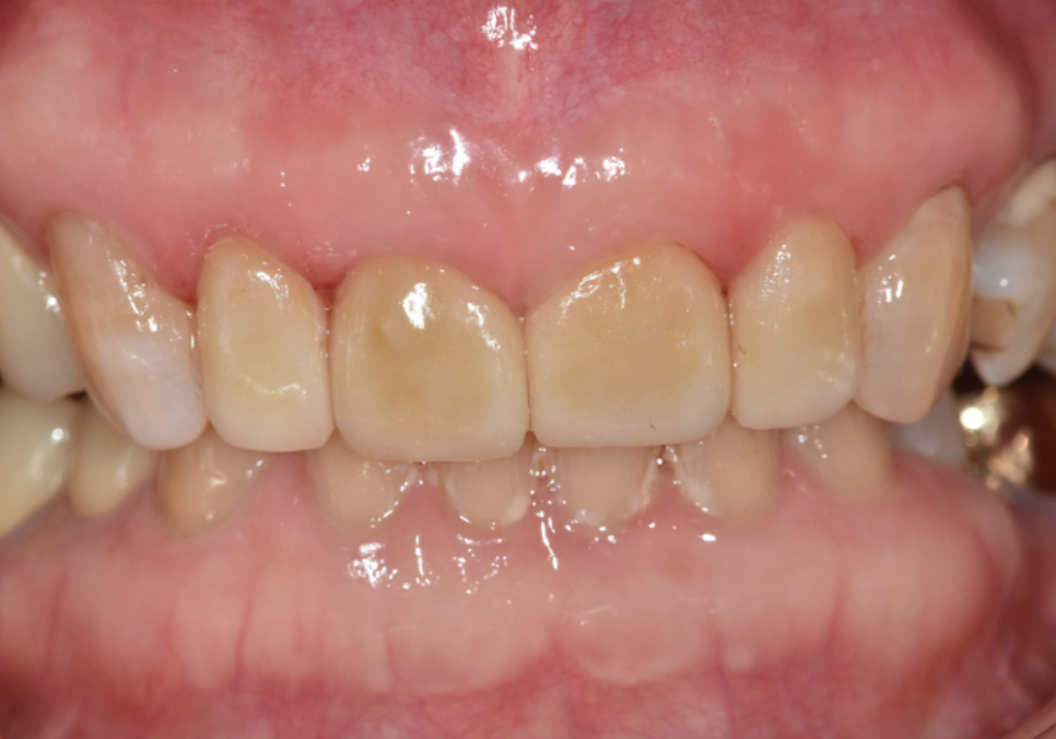 중장년 라미네이트, 70대도 가능한가요? 왜소치와 벌어진 앞니 해결 사례 관련 이미지 14