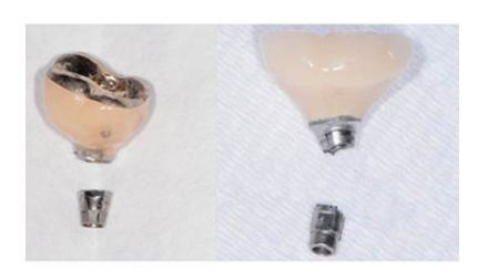 고덕동 치과 임플란트도 교체 주기가 있을까? 기준은? 관련 이미지 4