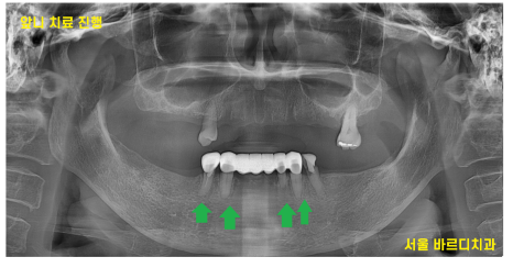 전체적인 치아 치료 13개의 임플란트를 식립한 환자분 관련 이미지 10