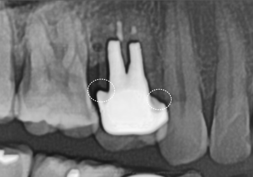 잇몸 까매짐 원인,증상,치료 방법 오래전에 앞니 씌운 곳 잇몸이 까매졌어요. 관련 이미지 2