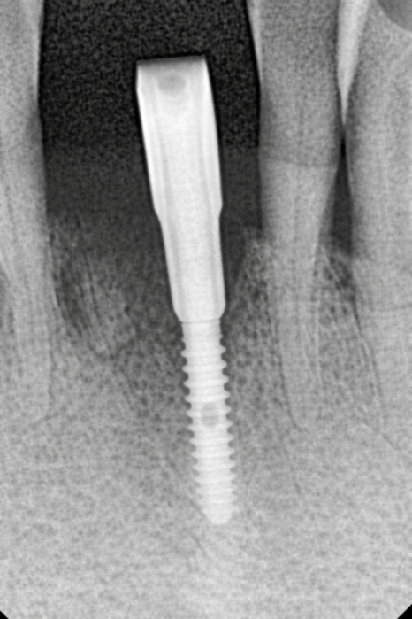 강동구 임플란트 가격 줄이는 방법 2개 발치했는데, 1개만 심어도 된다구요? 관련 이미지 8